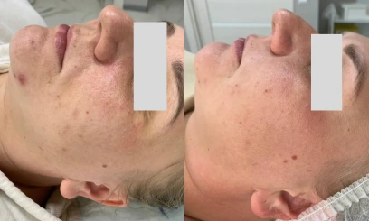 Лечебная чистка + химический пилинг по проблеме 2 